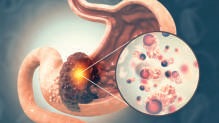 वृद्धेच्या पोटातून काढला दुर्मिळ कर्करोगाचा ट्युमर